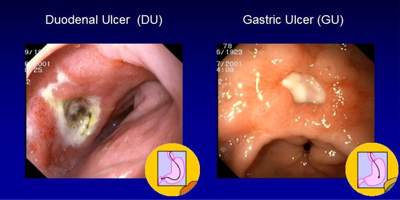 What foods should ulcer patients avoid?